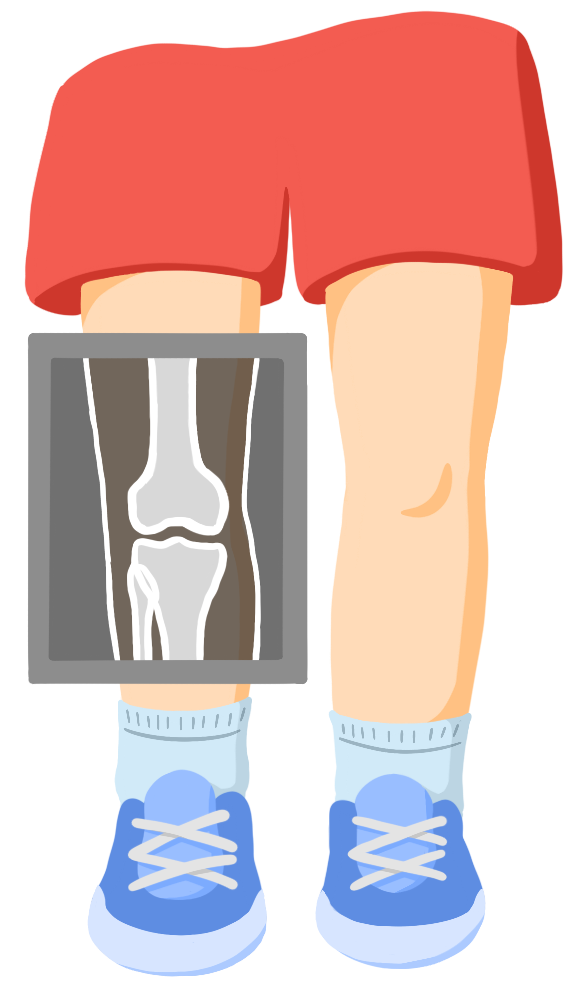 An X-ray over the leg shows the bones around the knee.